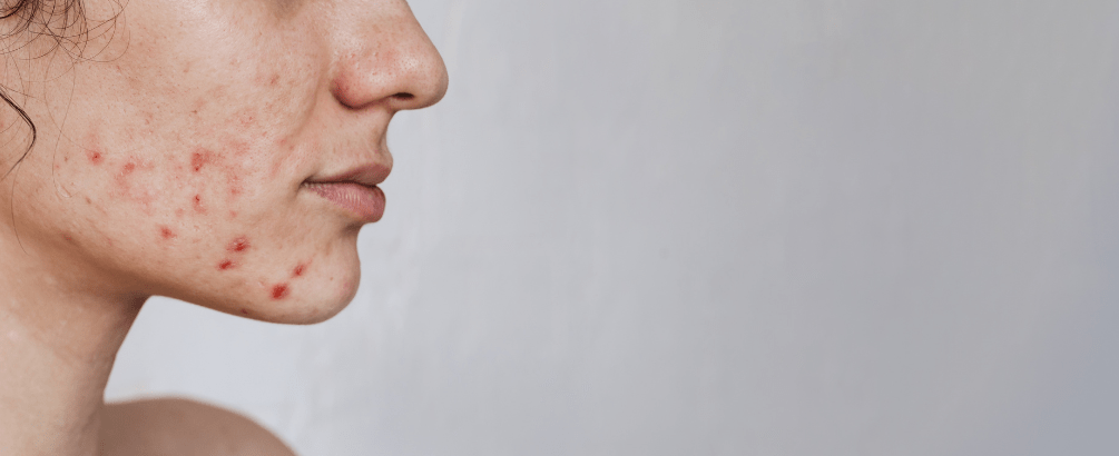 Does Drinking Water Help with Acne?